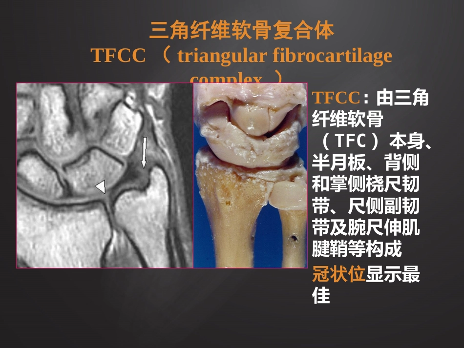 腕关节损伤MRI诊断_第12页