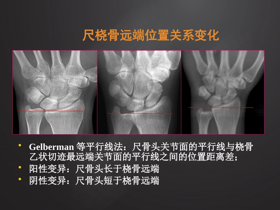 腕关节损伤MRI诊断_第14页