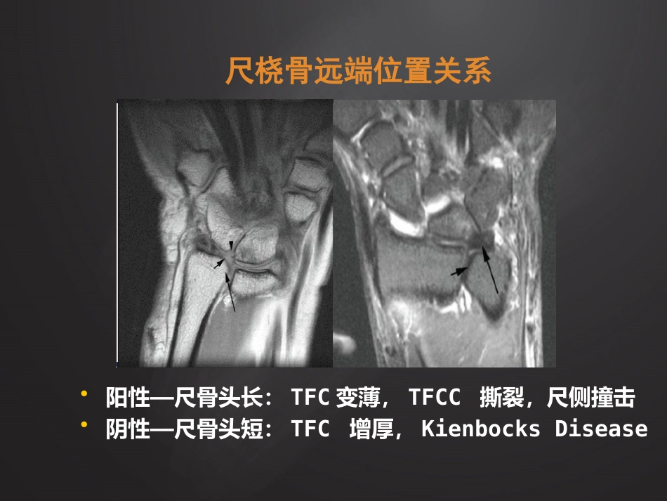腕关节损伤MRI诊断_第15页