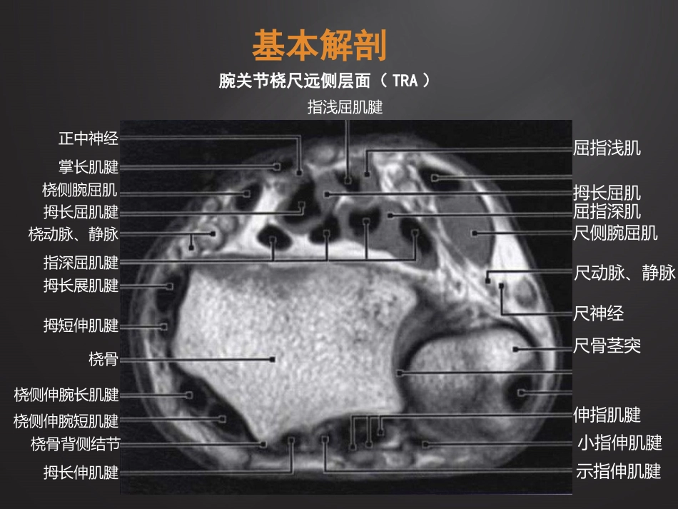 腕关节损伤MRI诊断_第4页