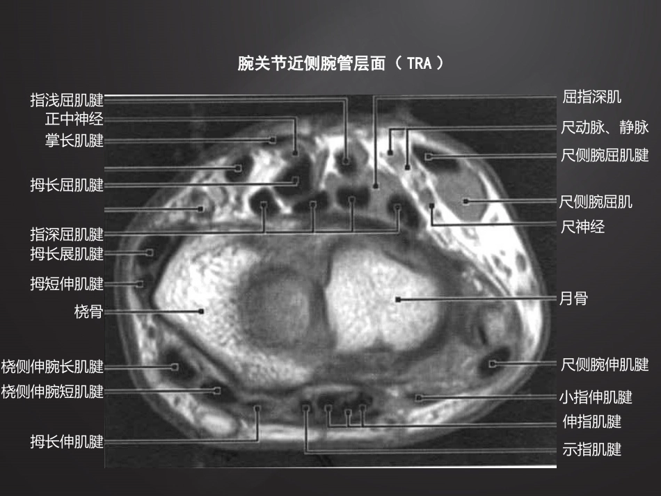 腕关节损伤MRI诊断_第5页
