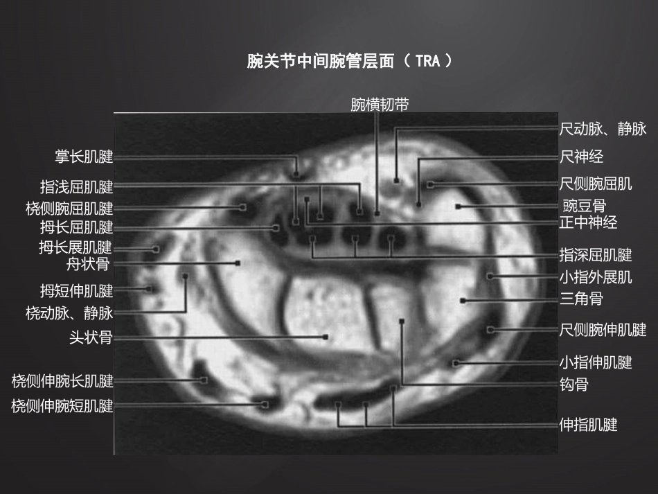 腕关节损伤MRI诊断_第6页
