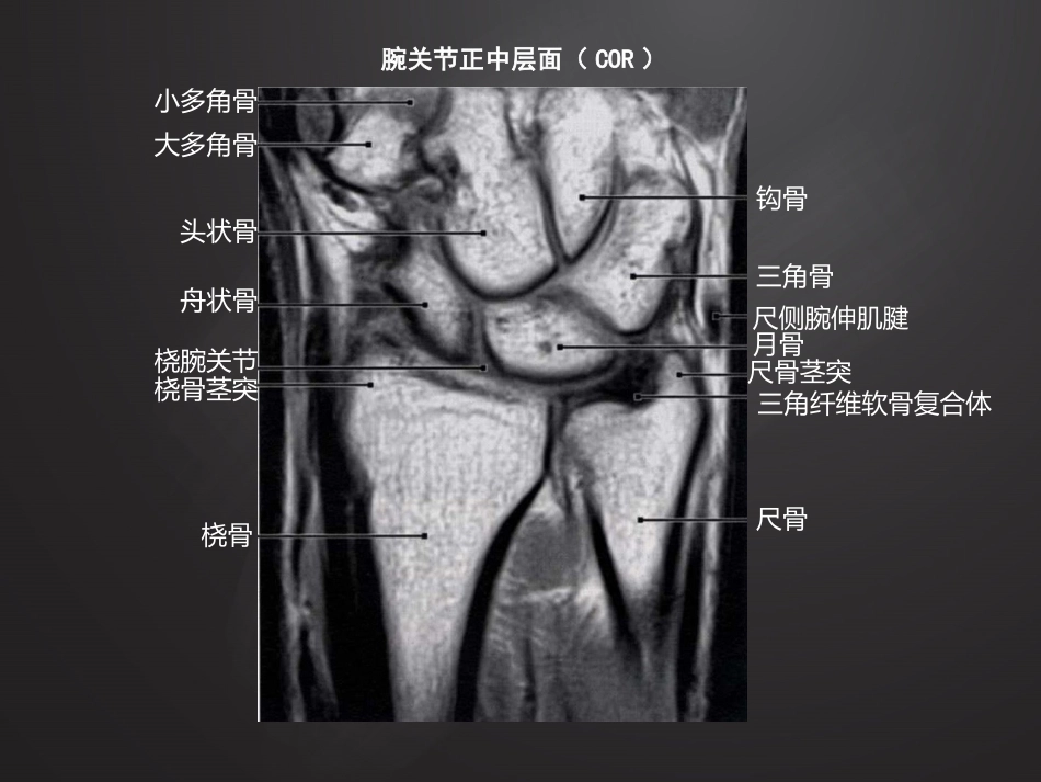 腕关节损伤MRI诊断_第8页