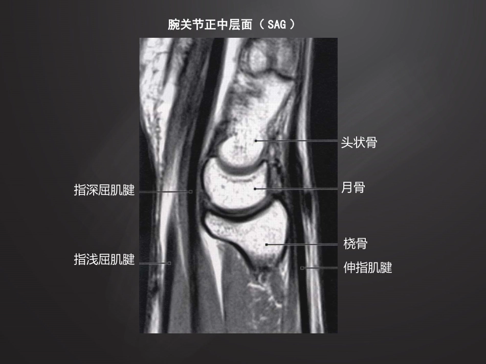 腕关节损伤MRI诊断_第9页