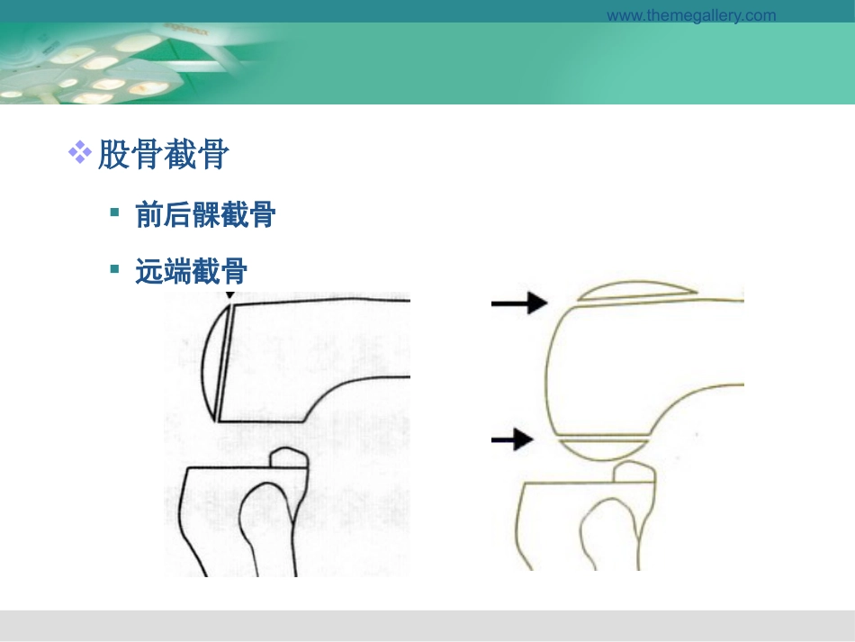 膝关节置换的手术操作和技巧_第12页