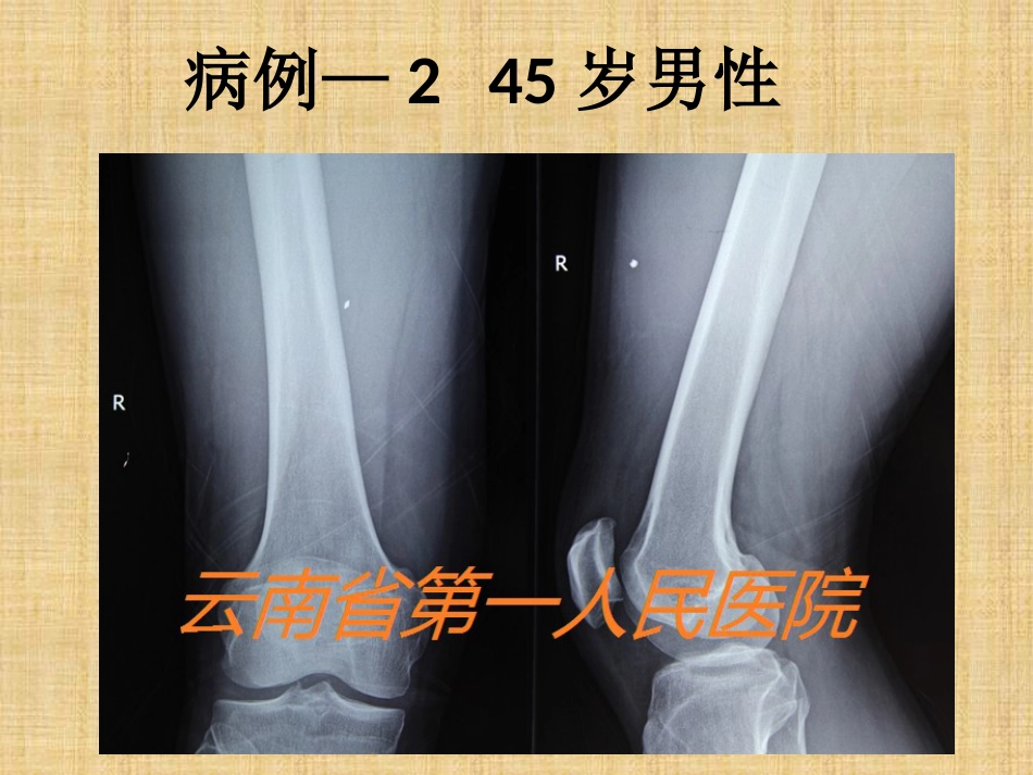 精准外科技术在四肢金属异物取出中的应用_第11页