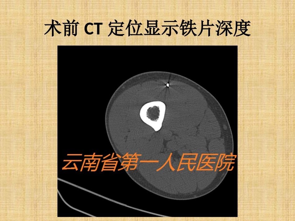 精准外科技术在四肢金属异物取出中的应用_第12页
