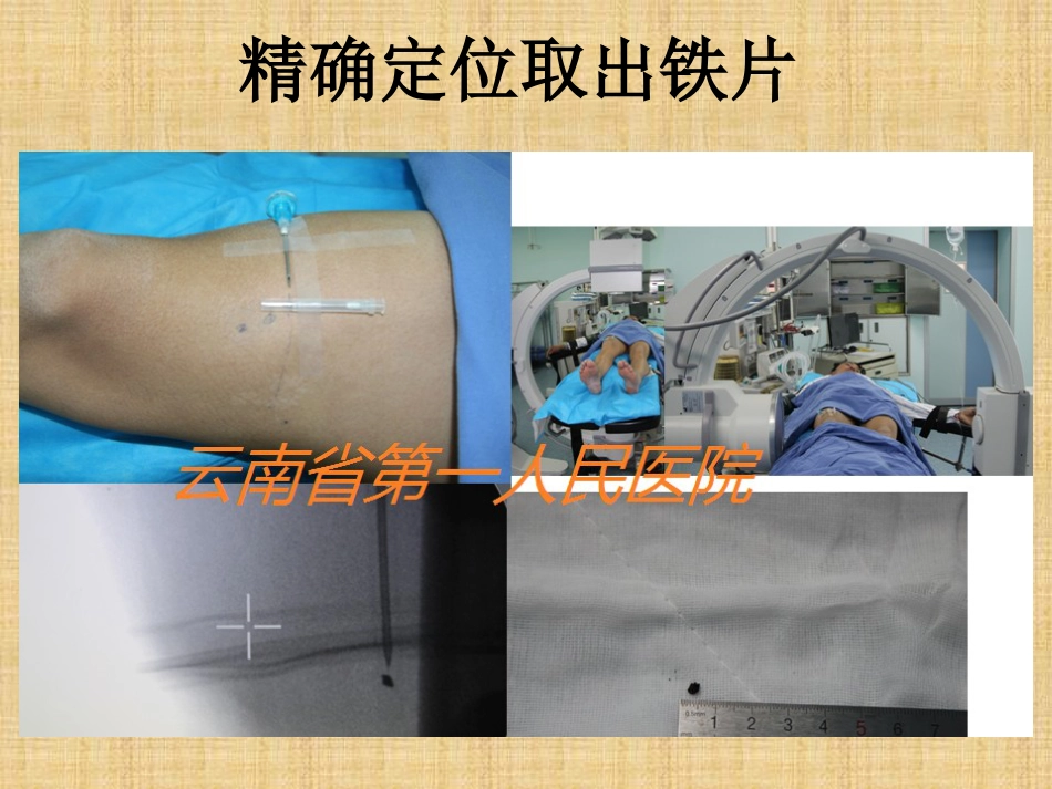 精准外科技术在四肢金属异物取出中的应用_第13页