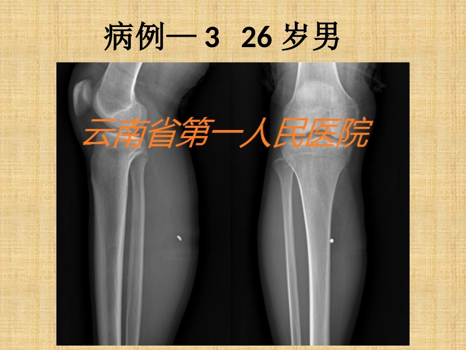 精准外科技术在四肢金属异物取出中的应用_第14页