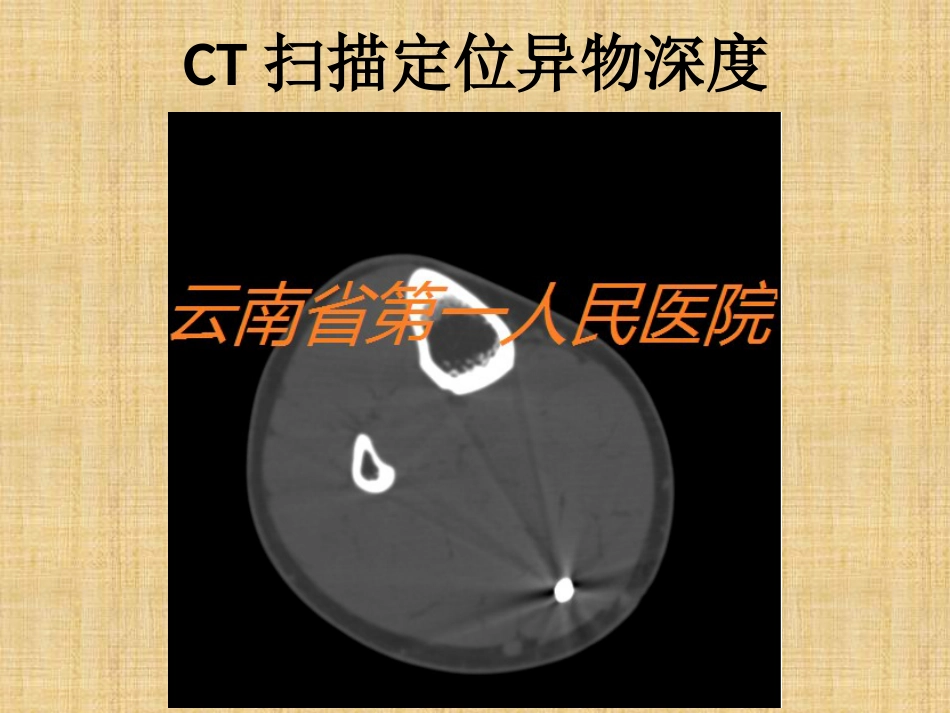 精准外科技术在四肢金属异物取出中的应用_第15页