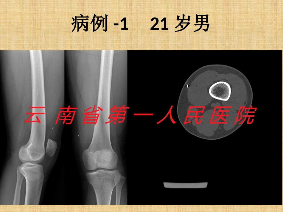精准外科技术在四肢金属异物取出中的应用_第9页