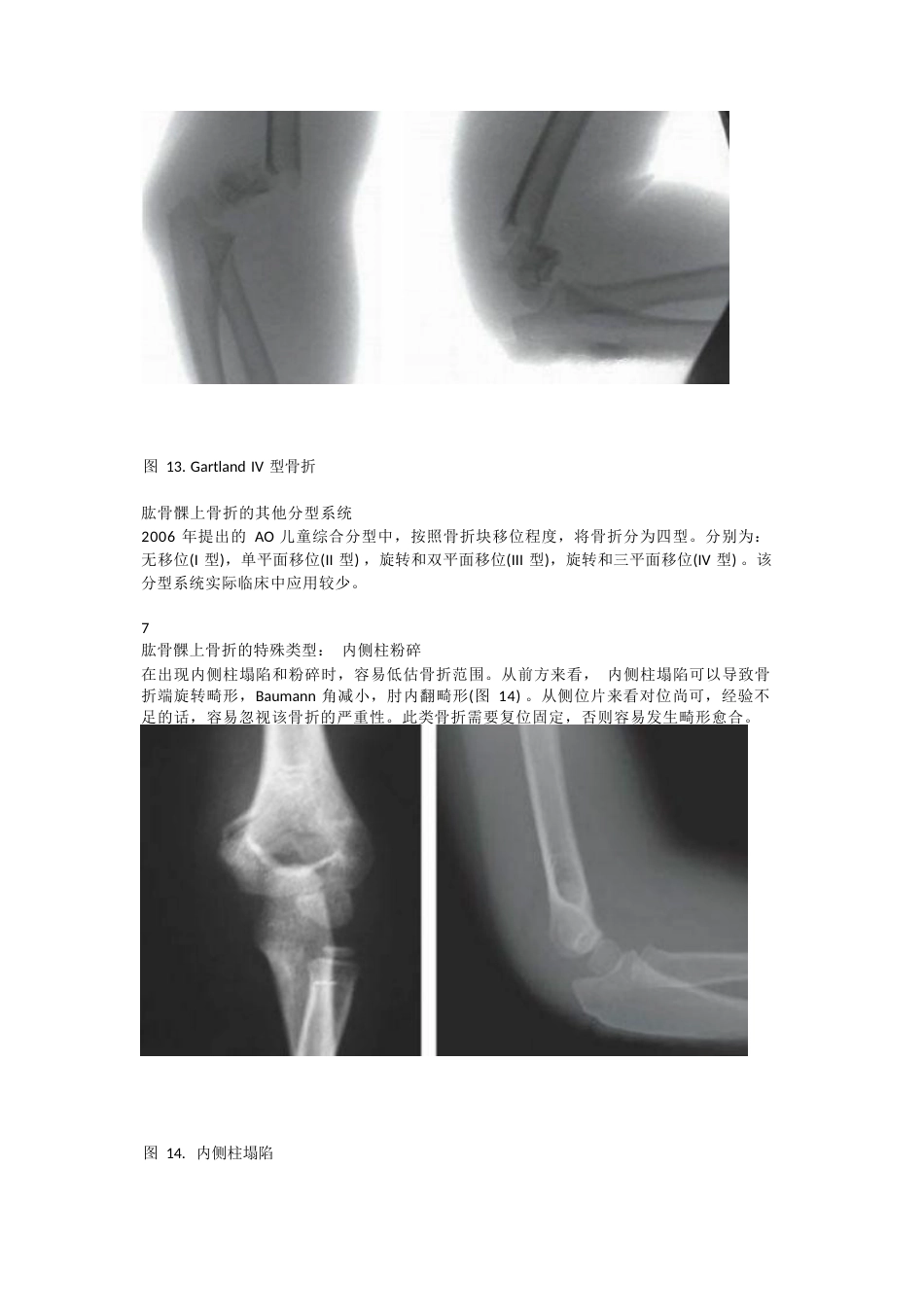 儿童肱骨髁上骨折的诊断及治疗要点_第11页