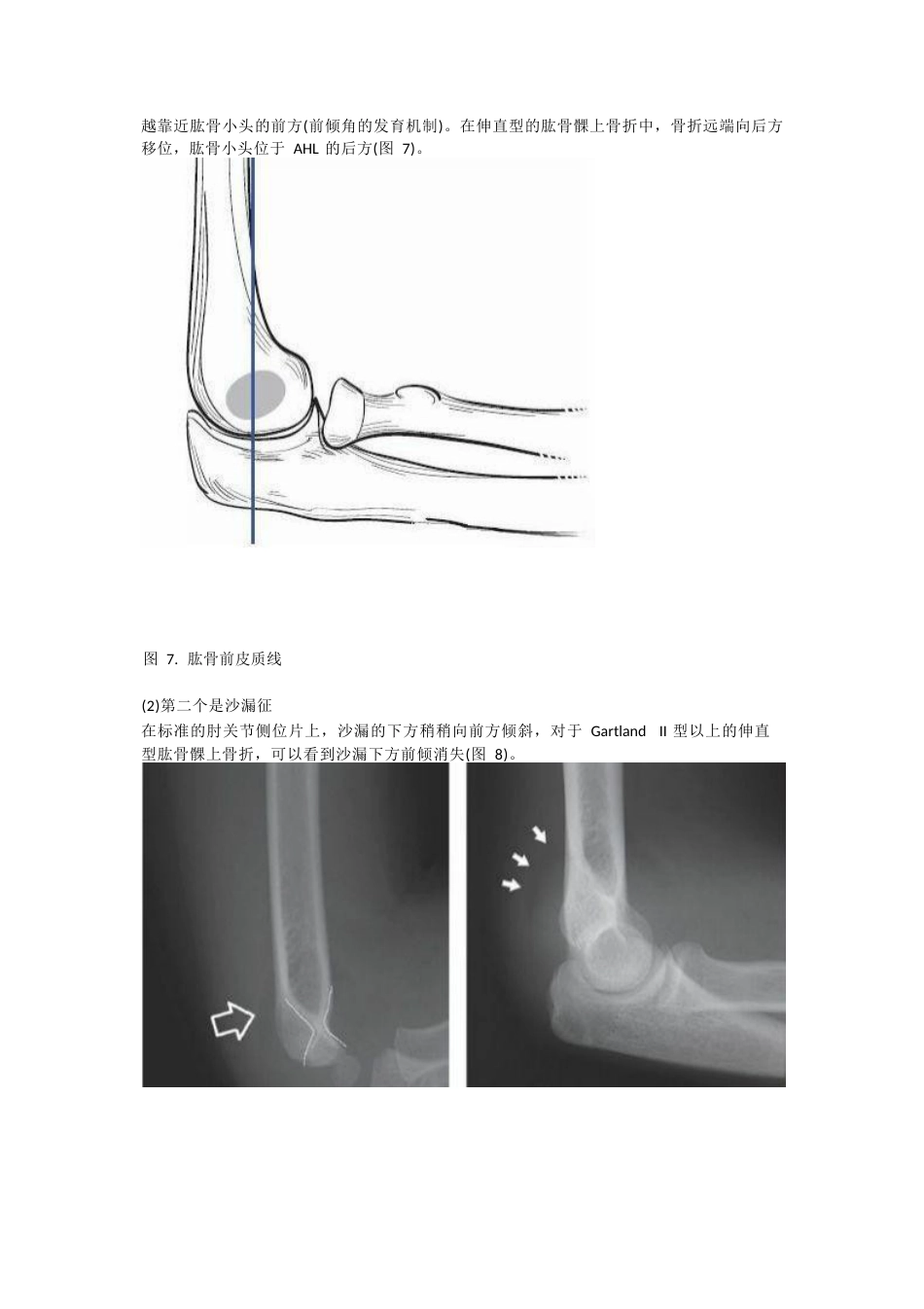 儿童肱骨髁上骨折的诊断及治疗要点_第6页