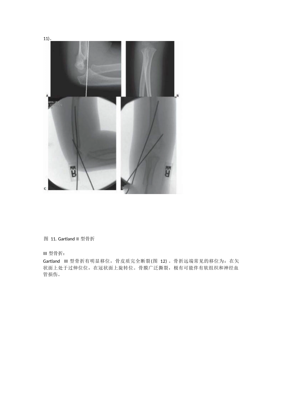 儿童肱骨髁上骨折的诊断及治疗要点_第9页