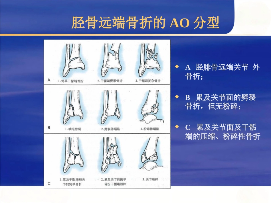 Pilon骨折的治疗_第8页