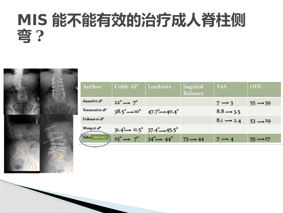 MISS治疗成人退变性脊柱侧弯_第13页