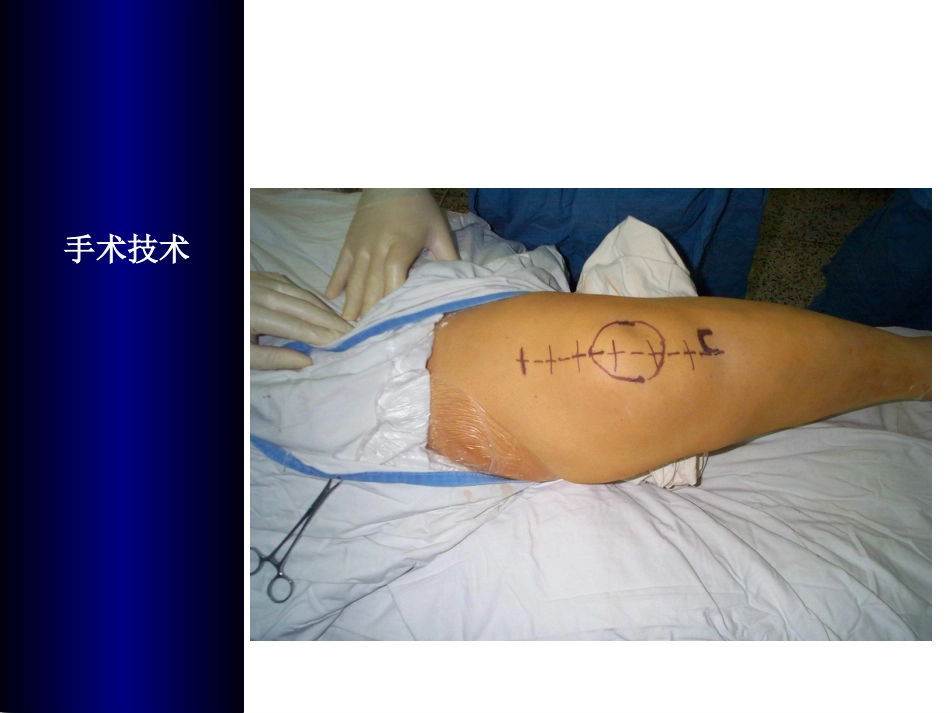全膝关节置换术培训_第12页