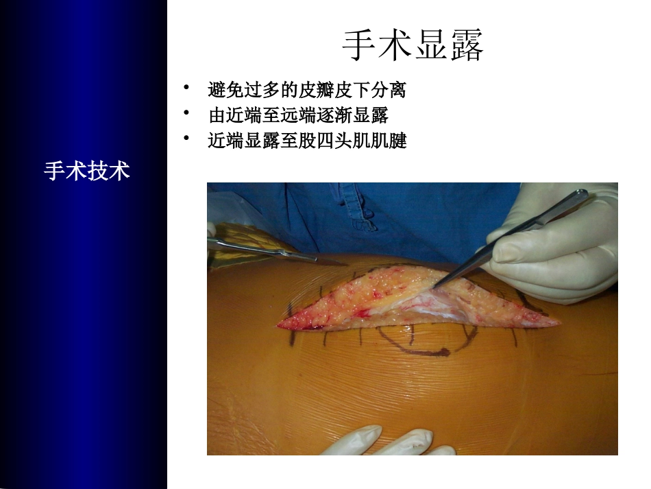 全膝关节置换术培训_第13页