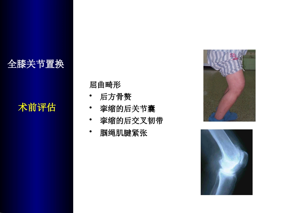 全膝关节置换术培训_第5页