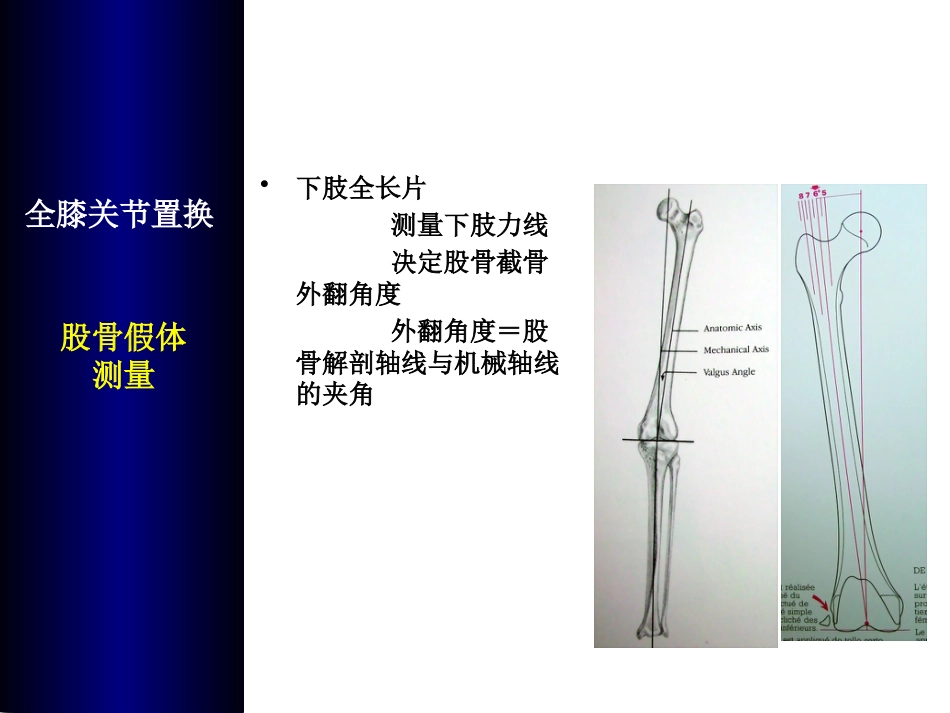 全膝关节置换术培训_第9页