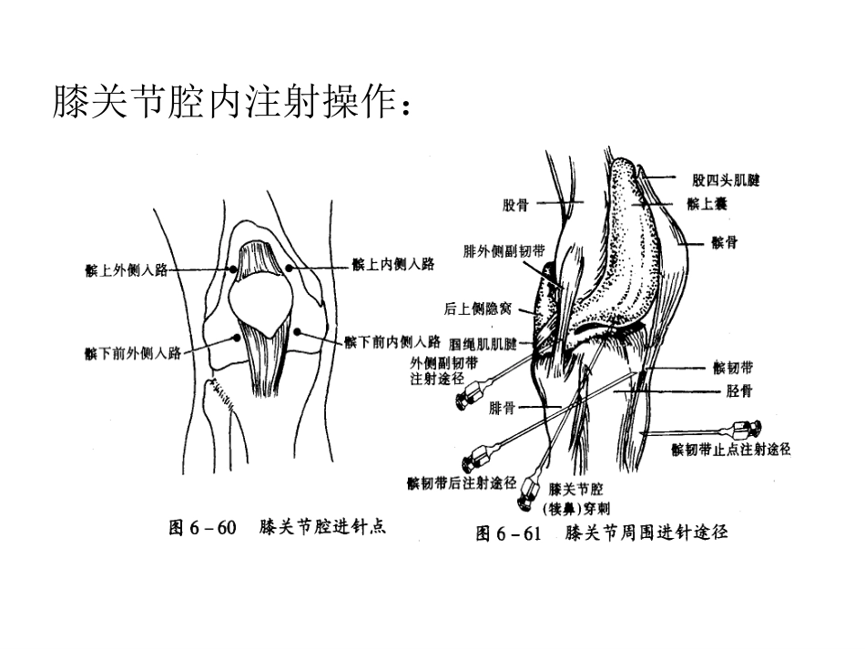 关节腔内穿刺注射_第13页