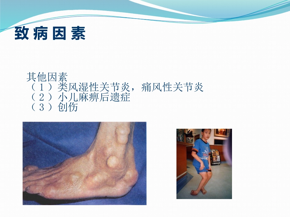 拇外翻的诊断治疗-ppt_第13页