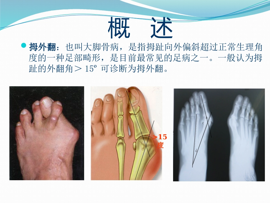 拇外翻的诊断治疗-ppt_第2页