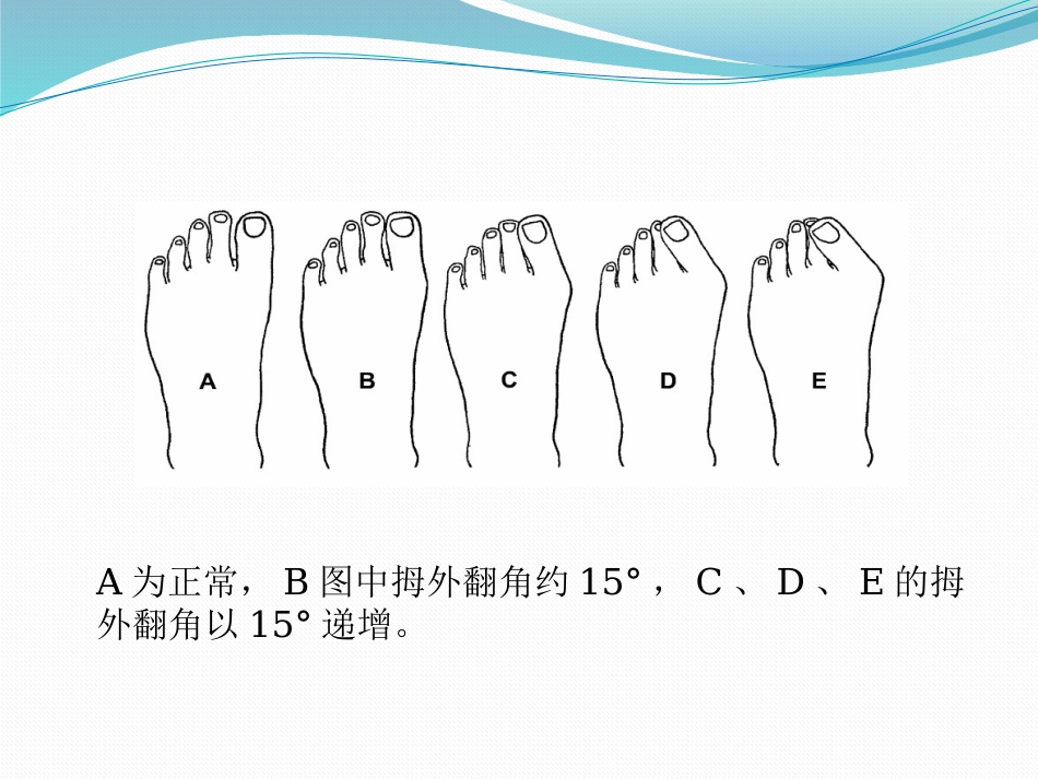 拇外翻的诊断治疗-ppt_第3页
