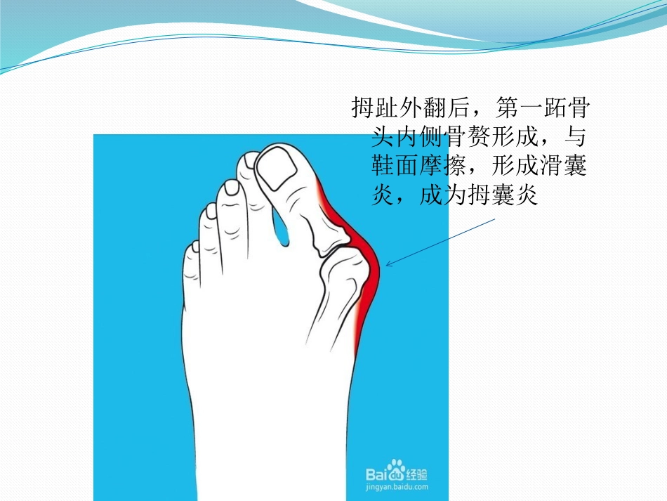 拇外翻的诊断治疗-ppt_第5页