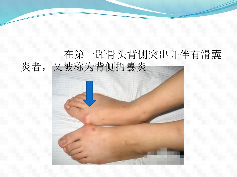 拇外翻的诊断治疗-ppt_第6页