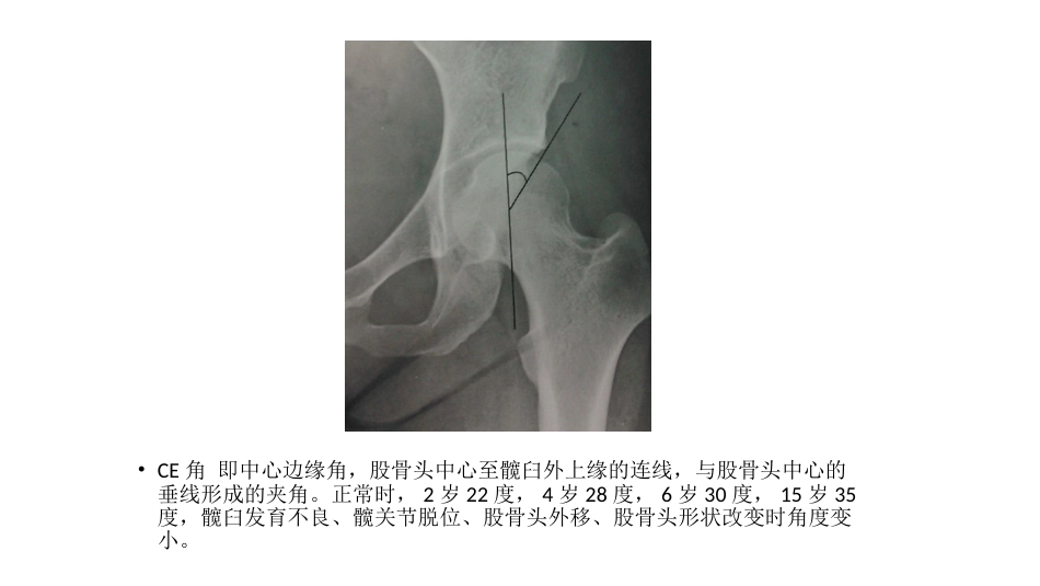 髋关节角度测量_第14页