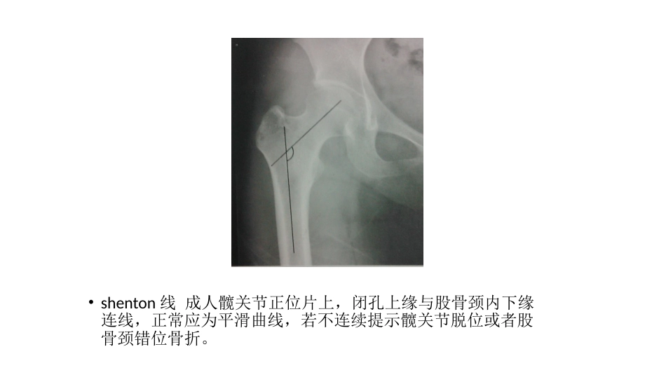 髋关节角度测量_第3页