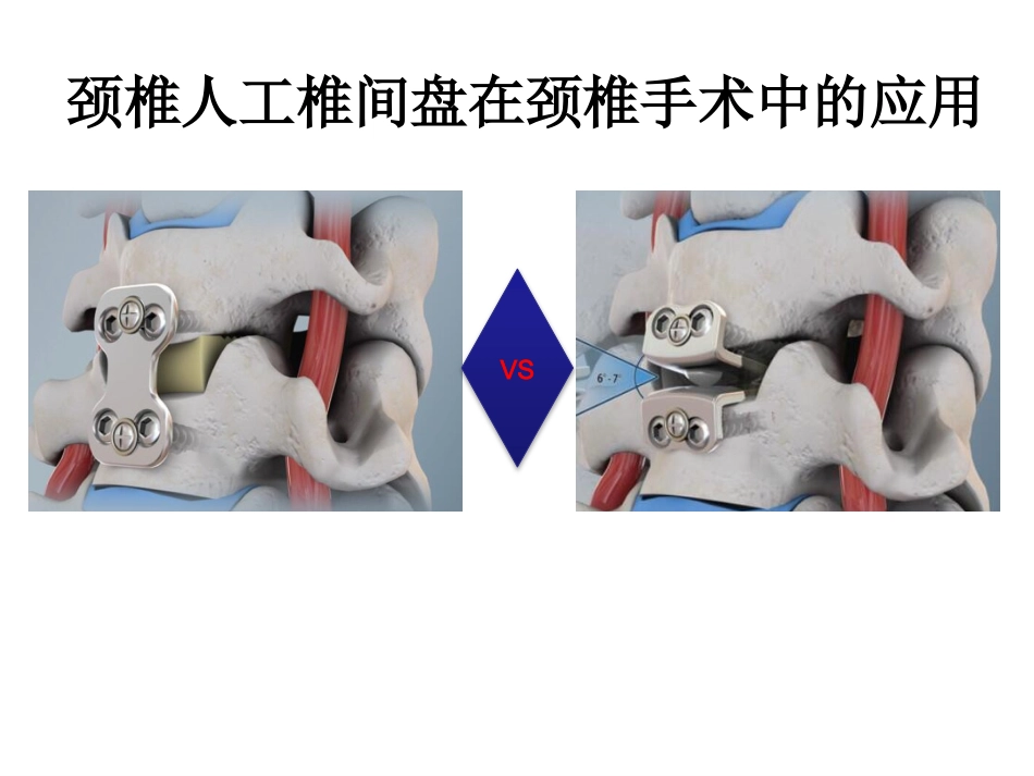 颈椎人工椎间盘CDR_第2页