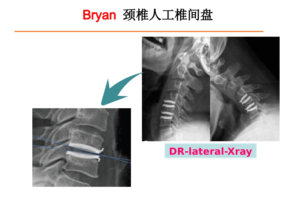 颈椎人工椎间盘CDR_第7页