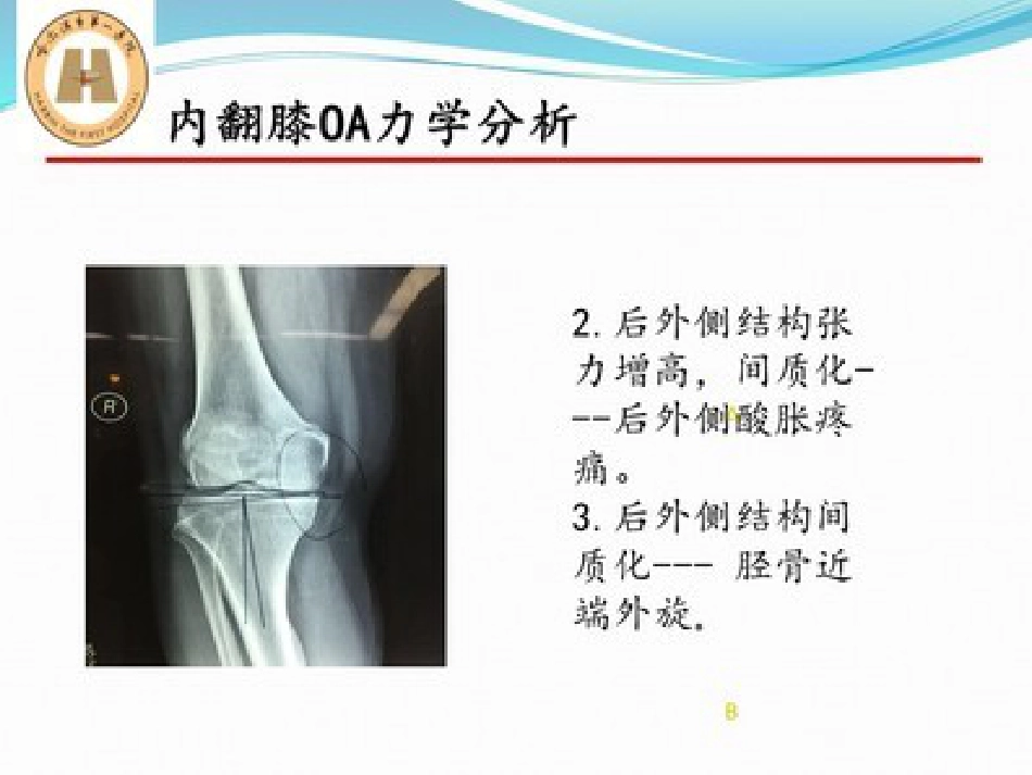 胫骨高位截骨治疗膝关节骨性关节炎_第15页