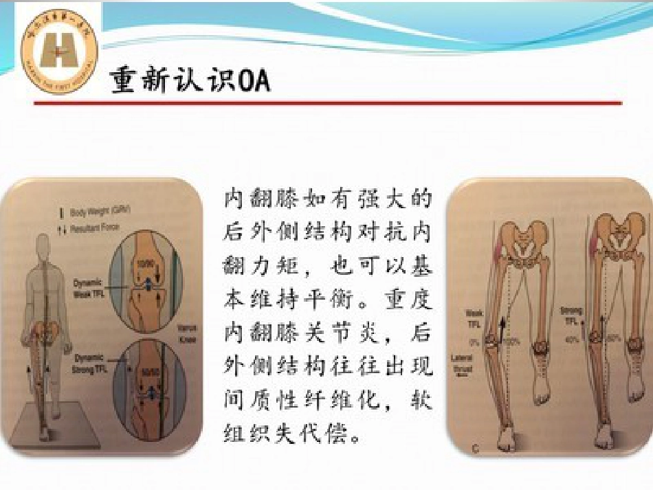胫骨高位截骨治疗膝关节骨性关节炎_第5页