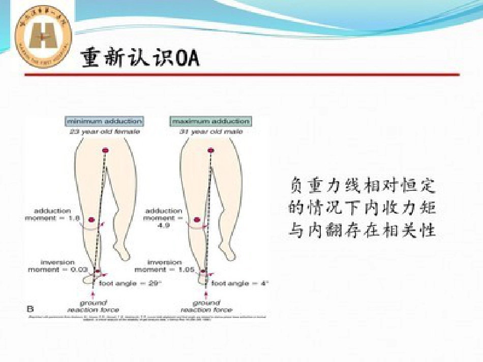 胫骨高位截骨治疗膝关节骨性关节炎_第6页