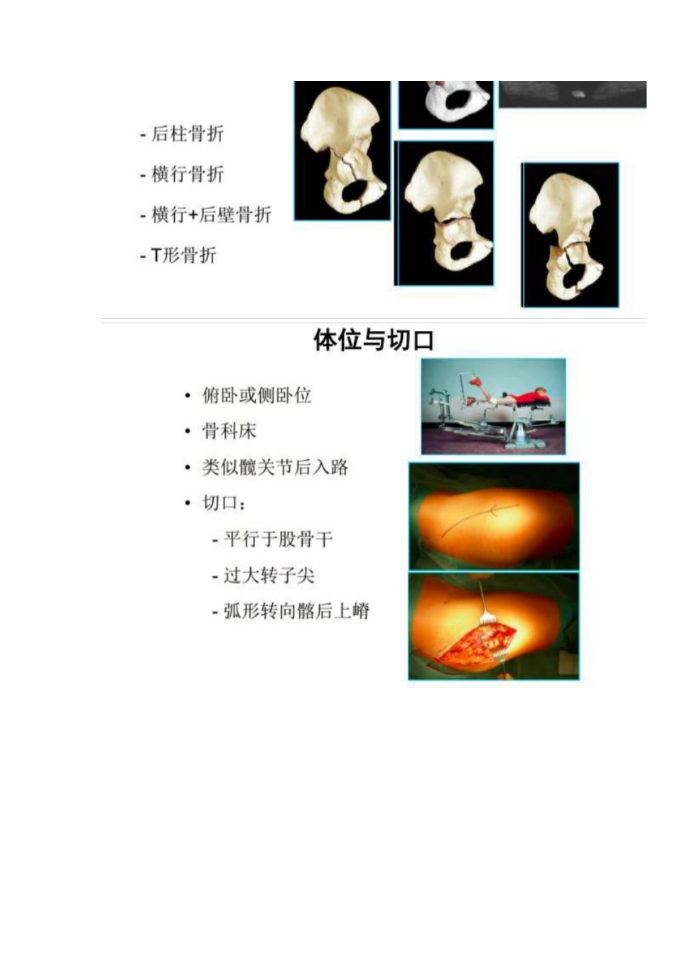 髋部骨折的手术入路及步骤_第10页