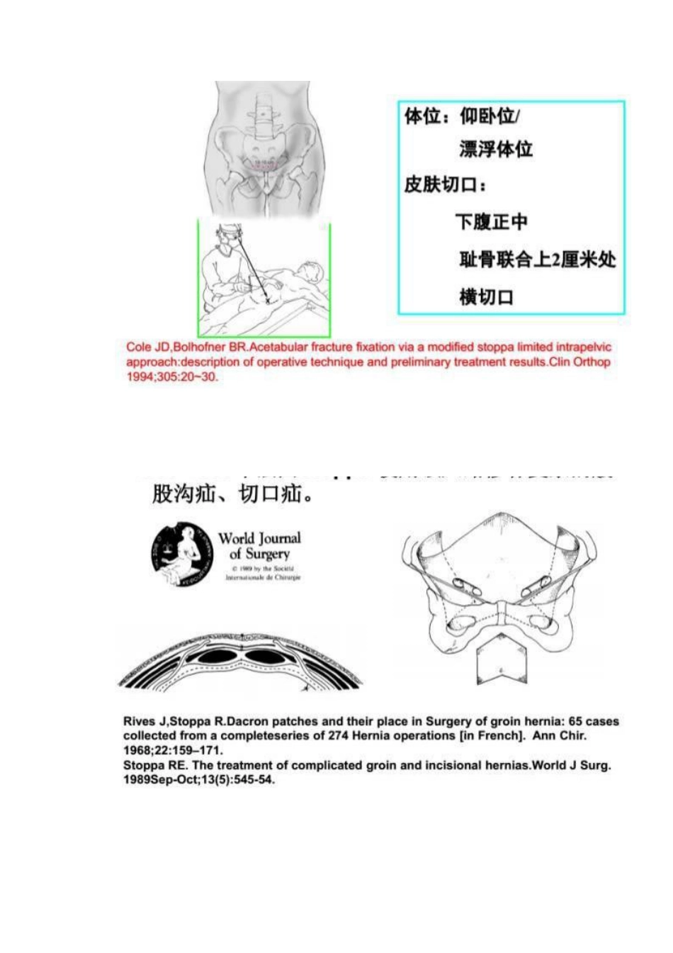 髋部骨折的手术入路及步骤_第13页