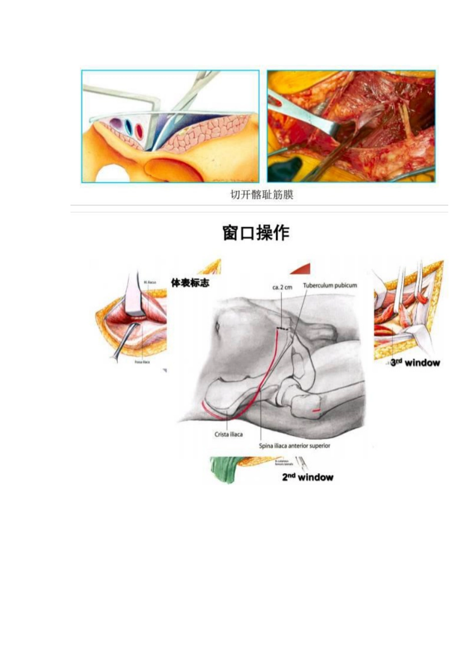髋部骨折的手术入路及步骤_第5页