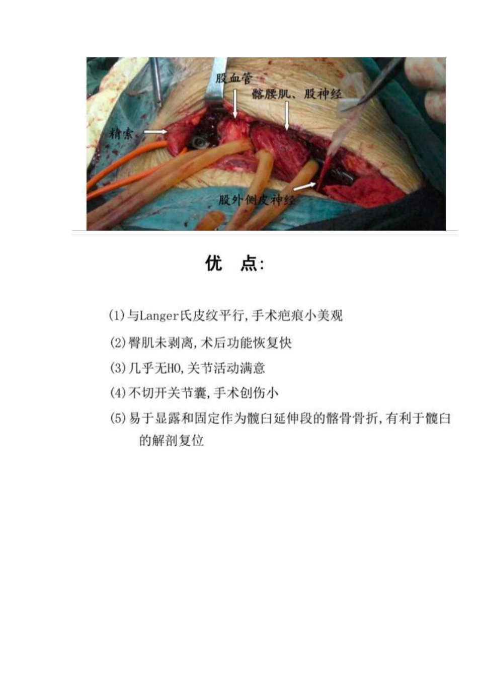 髋部骨折的手术入路及步骤_第6页