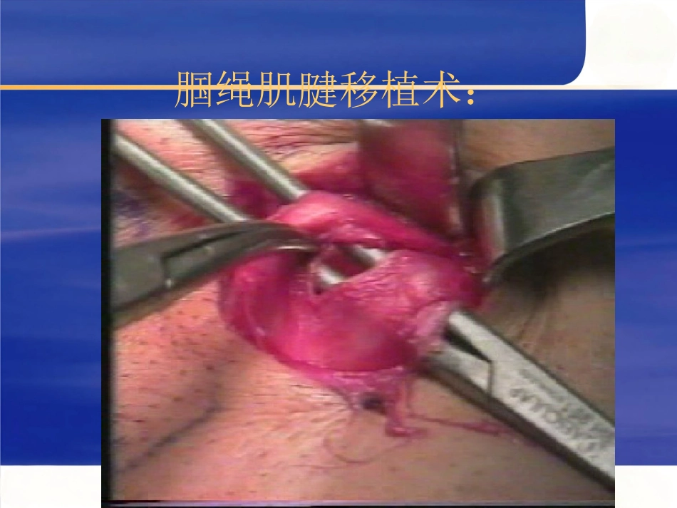 关节镜下膝前后交叉韧带重建术_第10页
