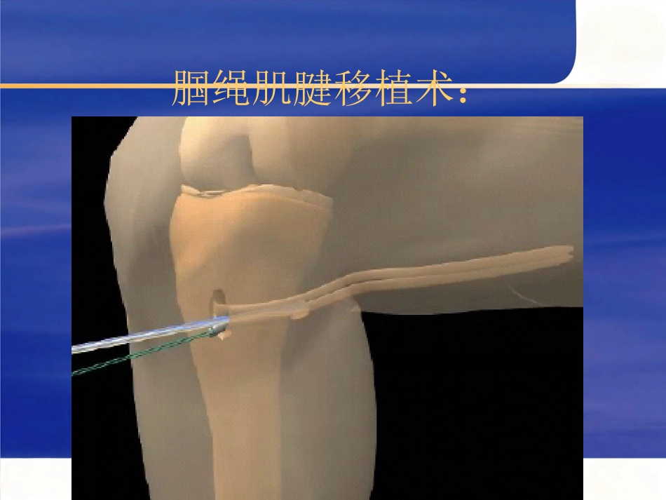 关节镜下膝前后交叉韧带重建术_第11页