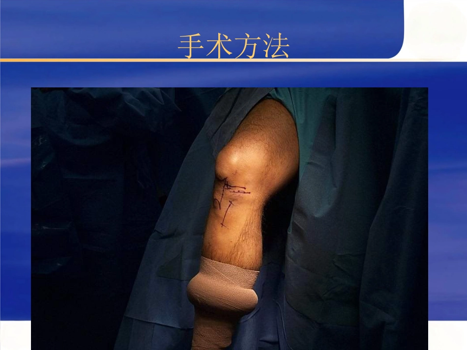 关节镜下膝前后交叉韧带重建术_第5页