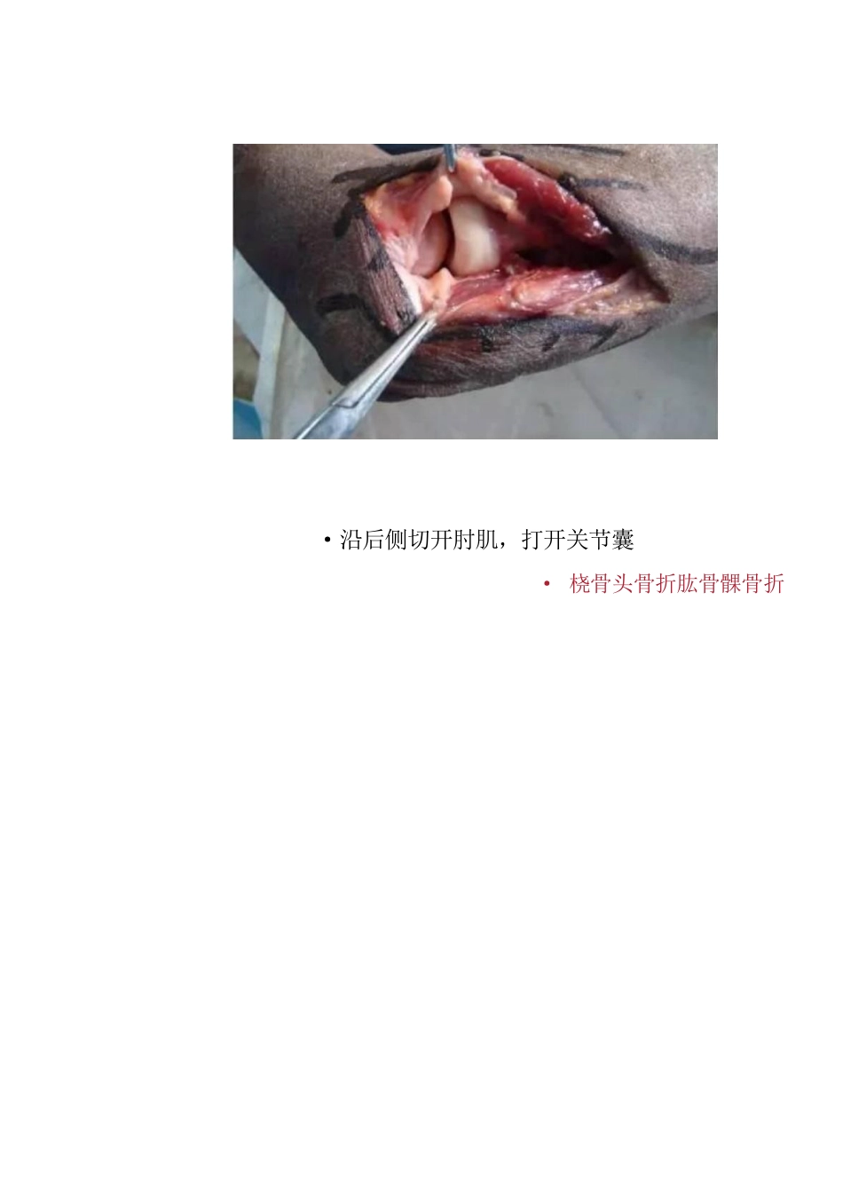 肘关节手术入路二_第15页