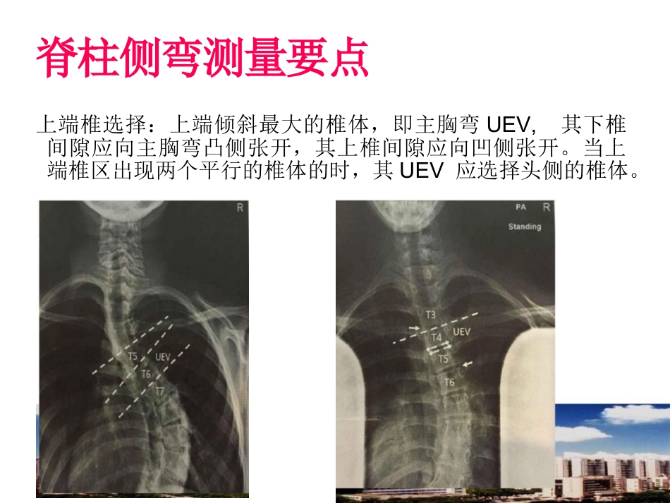 脊柱侧弯的诊断及治疗一_第11页