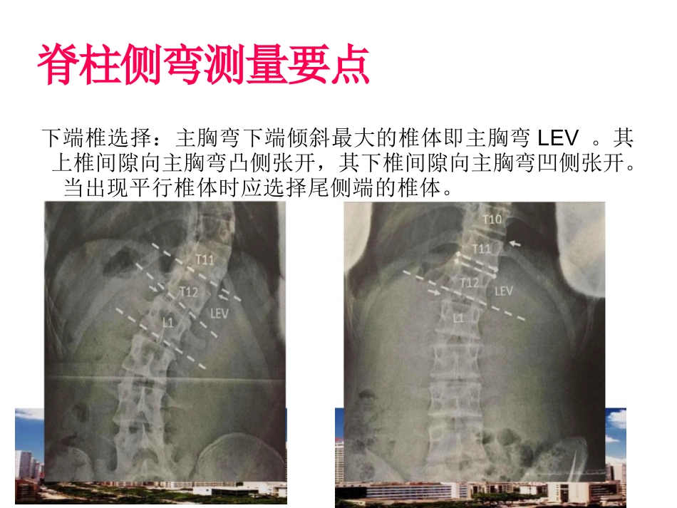 脊柱侧弯的诊断及治疗一_第12页