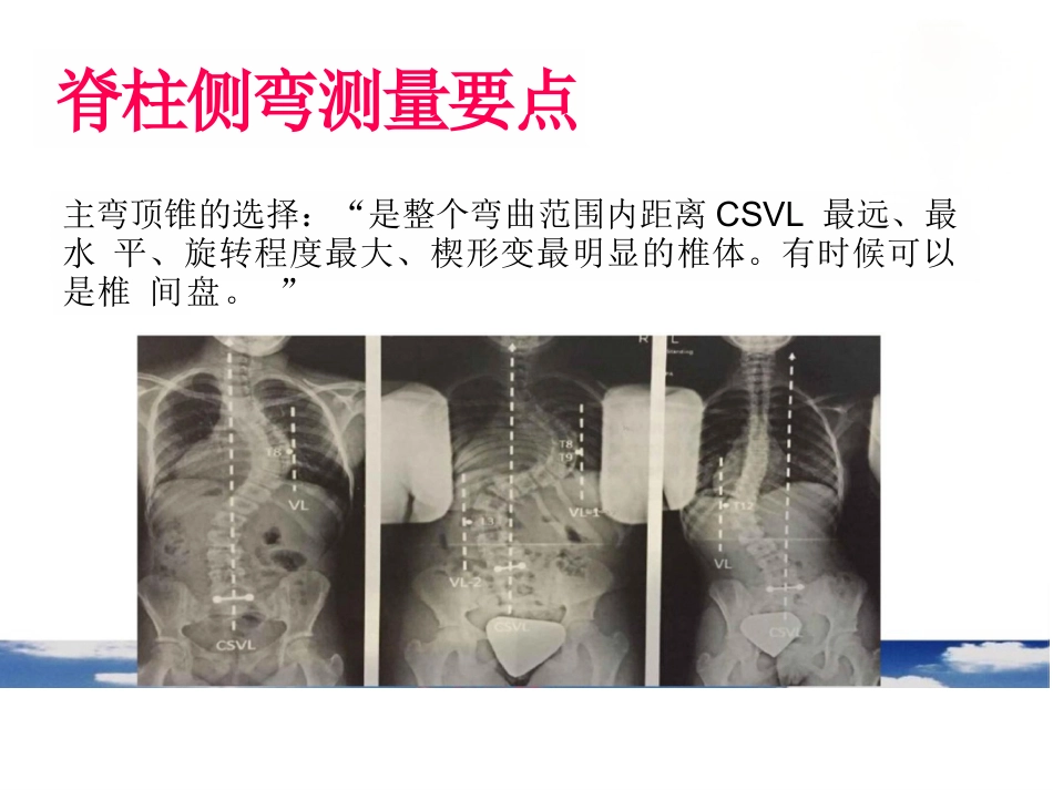 脊柱侧弯的诊断及治疗一_第13页