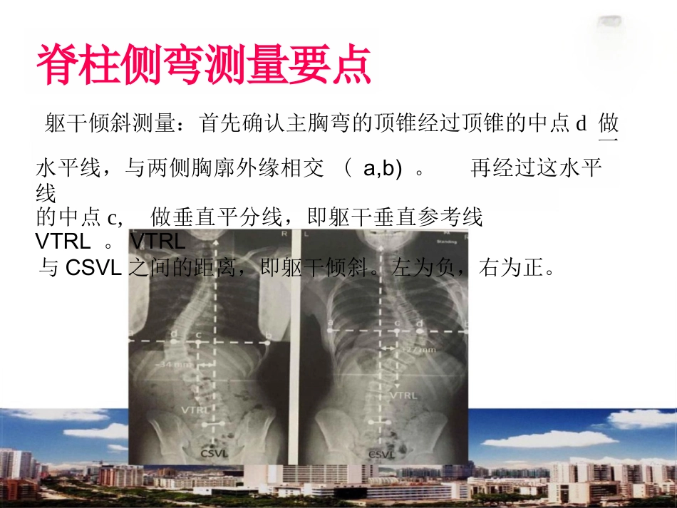 脊柱侧弯的诊断及治疗一_第14页