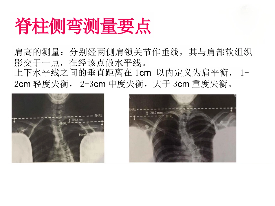 脊柱侧弯的诊断及治疗一_第15页